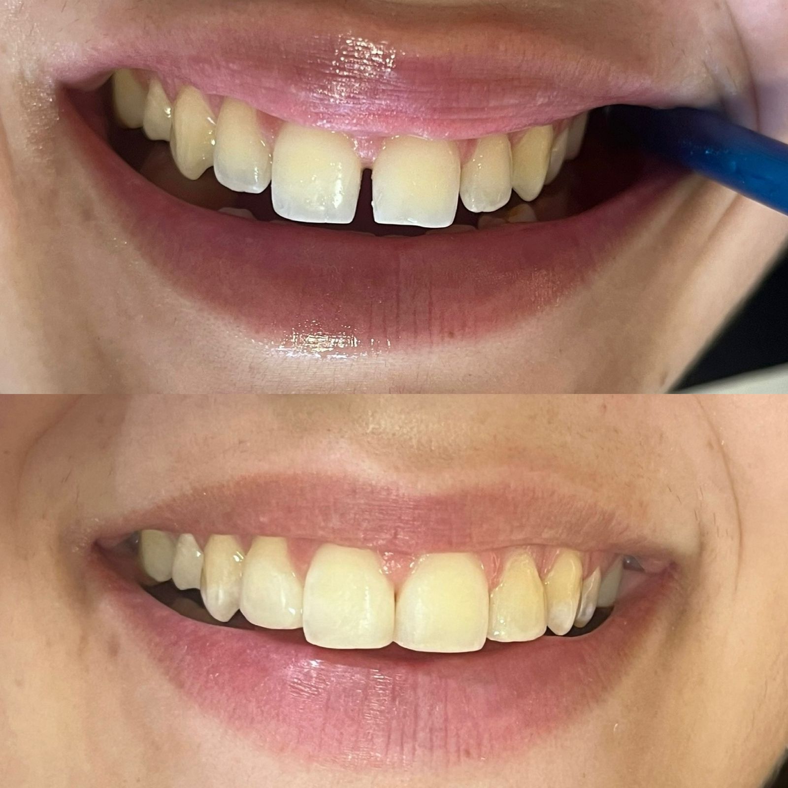 Dentista realizando restauração